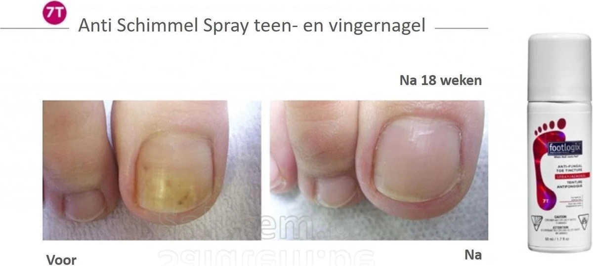 Footlogix Toe Nail Tincture Nagelspray - Afbeelding 2